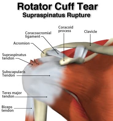 supraspinatus tendon tear shoulder treatment